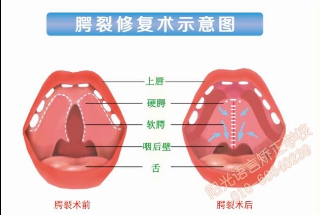 腭裂修复术示意图